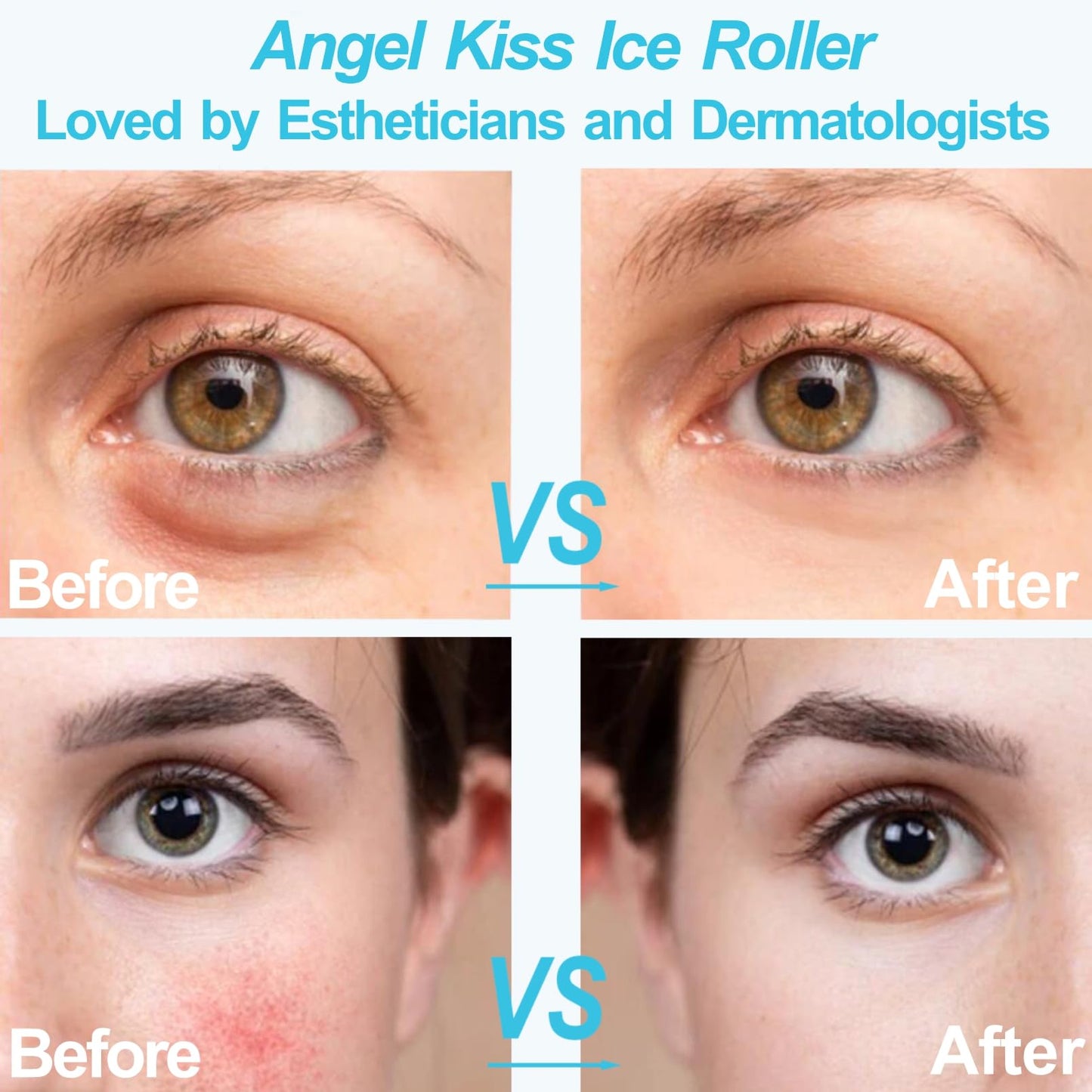 Angel Kiss Ice Roller for Face Eye, Women Gift Idea, Cold Therapy Massager for Reduce Puffiness, Redness, Dark Circles, Tightening Firming, Reduce Wrinkles, Migraine Pain Relief, w/Premium Carry Case Blue Roller