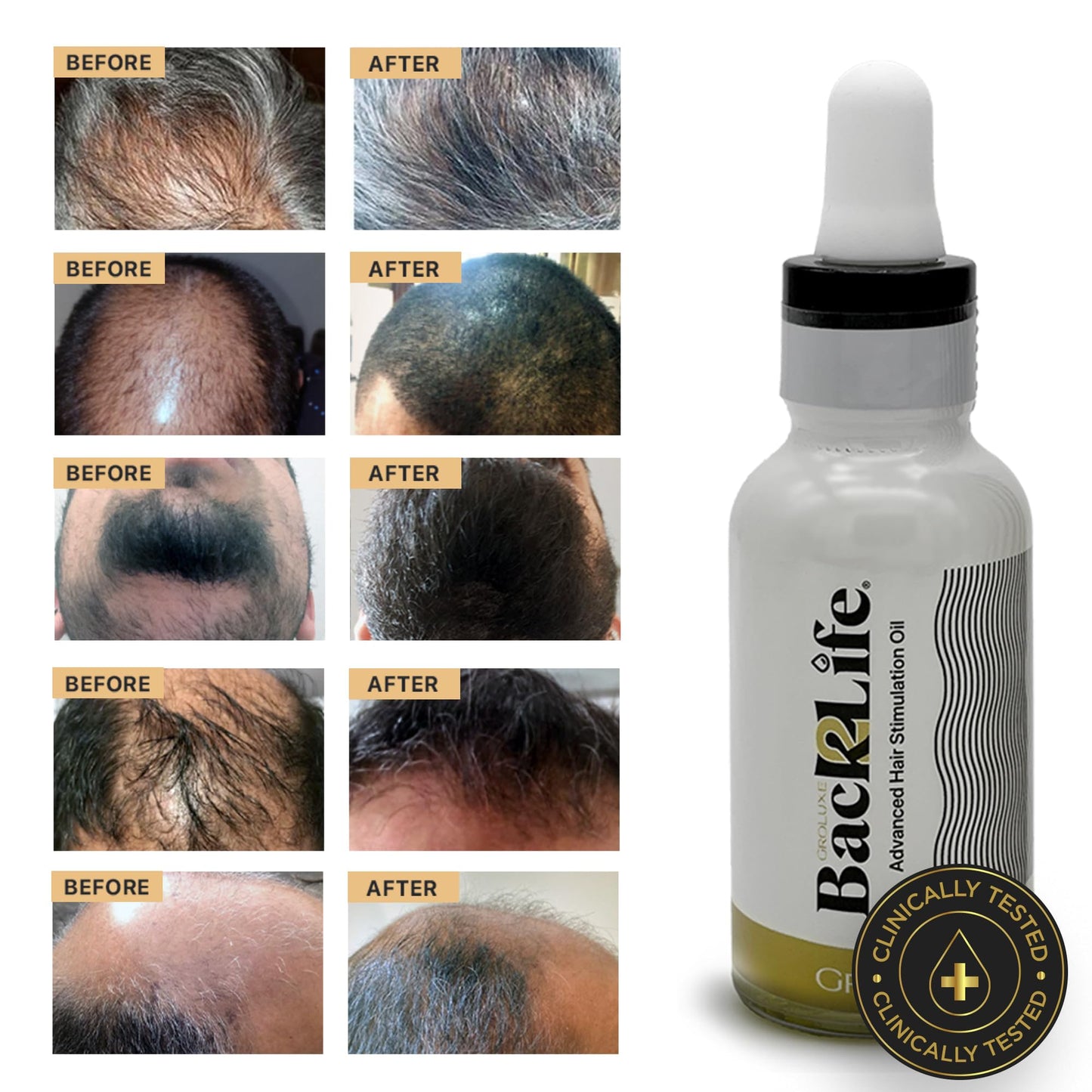 Back2Life 100% Natural Hair Stimulation & Beard Growth Oil-Get Rid of Patchy Beards & Hair-Beard serum to Moisturise, Hydrate & Condition-Repair & Rebalance Your Scalp & Regrow your Head & Beard Hair